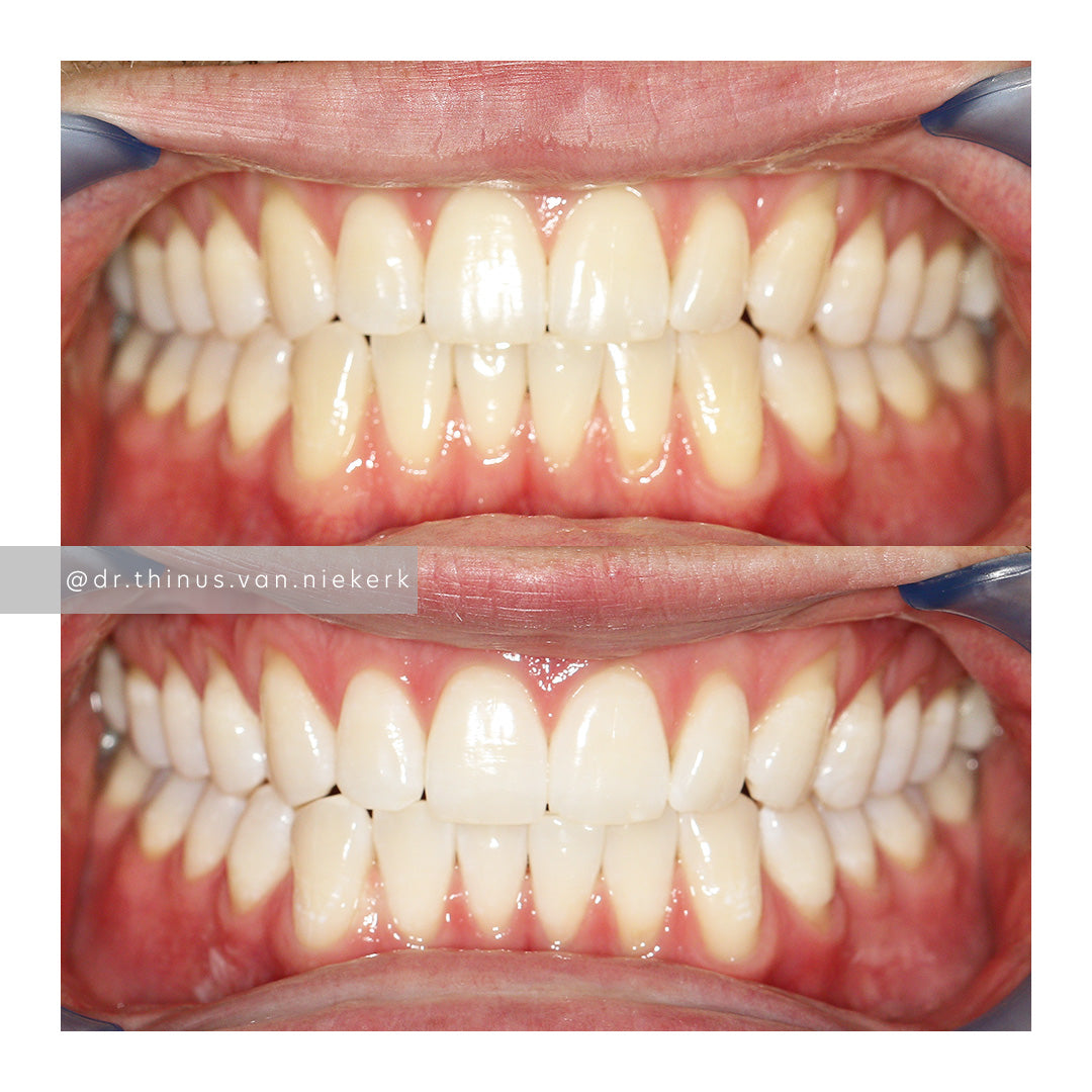 Before and after teeth whitening results