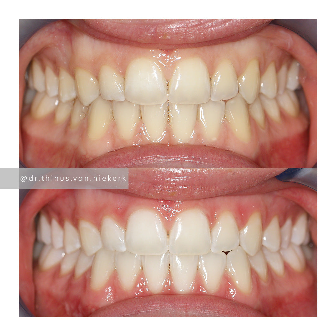 Before and after teeth whitening results