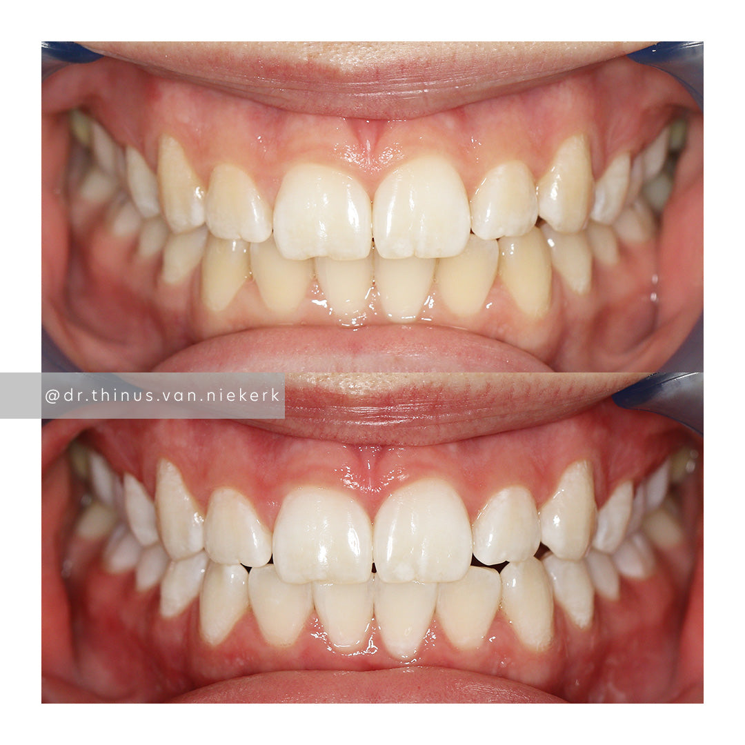 Before and after teeth whitening results